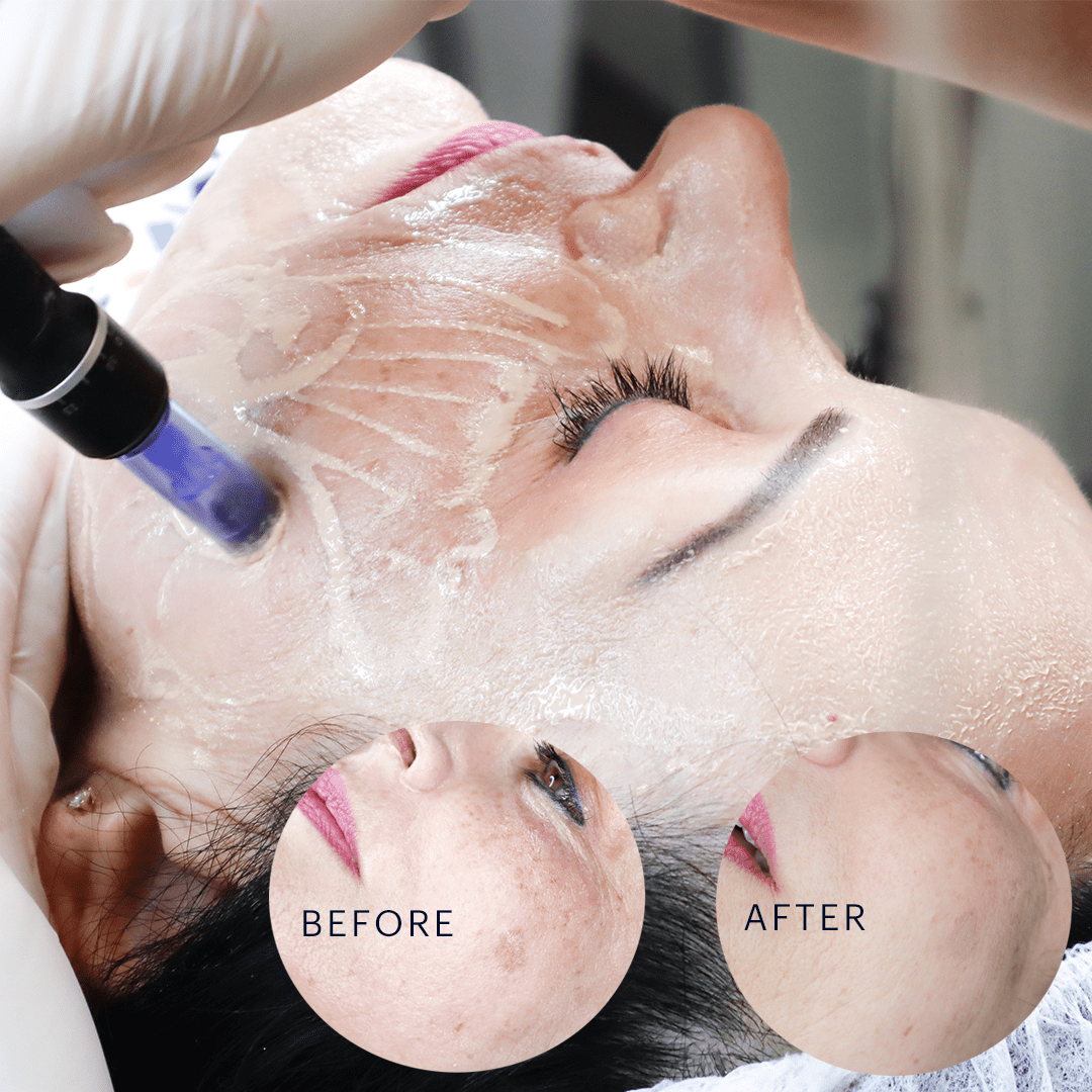 EI Skin Needling/BB Glow Meso Cartridges (10pcs)